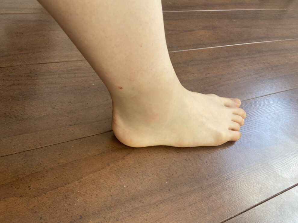Mijn voet na de behandeling 